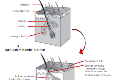 Cara Menghilangkan Bisul Beserta Pencegahannya