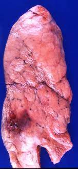 smokers lungs pictures