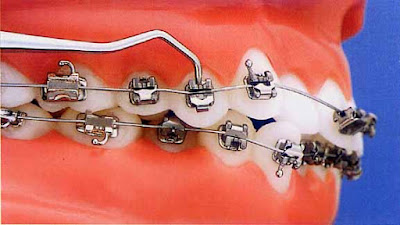 Cách phòng ngừa tác hại của việc niềng răng sai cách