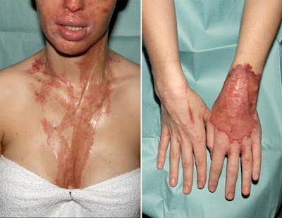 Katie Piper sulfuric acid attack photos