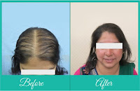 Hair transplant