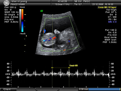 3D Nuchal scan of foetus