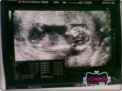 Baby Melambai Masa Scan 12 Minggu dan Ubat Tahan Muntah 