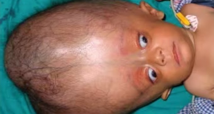 Diagnóstico precoce e cirurgia salvam bebê com síndrome de Dandy Walker