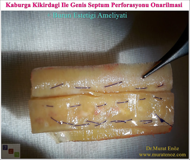 Nazal septum perforasyonu - Septum perforasyonu ameliyatı olanlar - Septum perforasyonu olanlar - Septum perforasyonu ameliyatı yapan doktorlar - Burunda delik oluşumu - Burun duvarında delik - Burun kıkırdak delinmesi tedavisi - Septum perforasyonu ameliyatı olanlar - Septum perforasyonu olanlar - Septal perforasyon tamiri - Septal buton uygulaması - Nazal septum perforasyonu tedavisi - Nazal septum perforasyonu nedenleri - Nazal septum perforasyonu belirtileri - Septum perforasyonun cerrahi onarımı - Burun delinmesinin nedenleri - Nazal septum perforasyonu tanısı - Erkek burun estetiği - Burun estetiği ameliyatı - Definition of Nasal Septal Perforation - Causes of Perforated Nasal Septum - Symptoms of Nasal Septal Perforation - Diagnosis of Nasal Septal Perforation - Surgical Treatment For Nasal Septal Perforation - Nasal Septal Perforation Repair - Surgical Repair of Nasal Septal Perforation