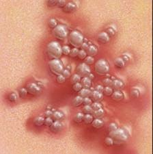 Obat Herpes Pengobatan Alternatif Untuk Herpes Genital