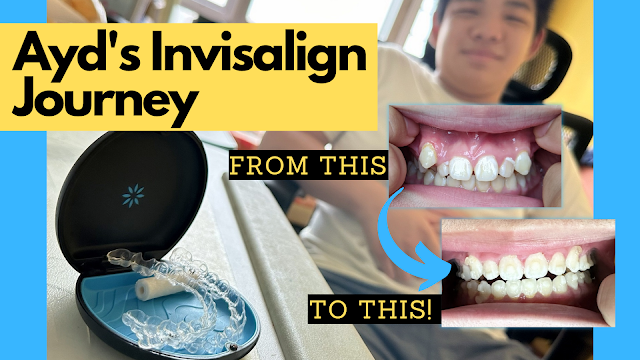 Thinking of getting braces for your teen? Here’s how Invisalign helped Ayd Cheekie Monkies