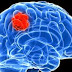 ¿Qué causa el cáncer de cerebro ?