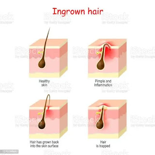 What Is Ingrown Hair