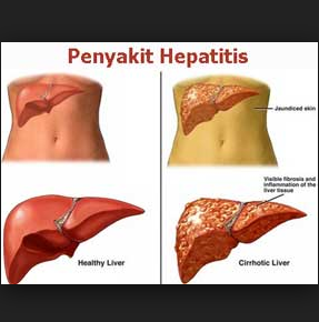 Hepatitis Reasons Symptoms and Ayurvedic Treatment