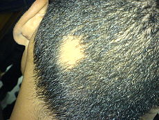 spot baldness-treatment and prevention