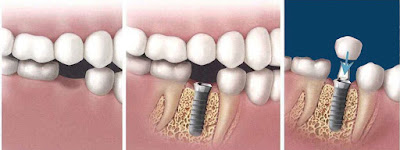 Trường hợp nào không nên cấy ghép răng Implant?