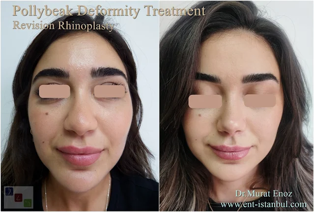 Polly-beak nose deformity,Pollybeak Deformity,Parrot Beak Deformity,Polly beak deformity,revision rhinoplasty,
