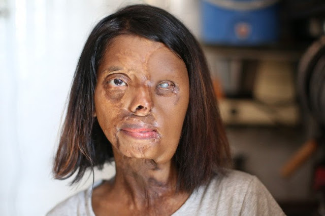 shabbo sheikh acid attack survivor