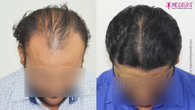 Hair transplant in India