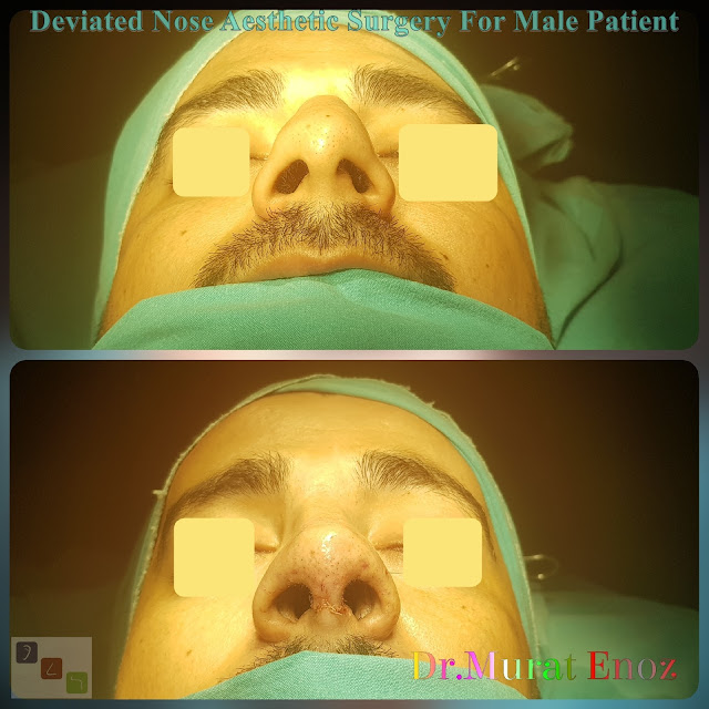 Deviated Nose Aesthetic Surgery, Asymmetric Nose Correction Operation,Rhinoplasty in Men Istanbul,