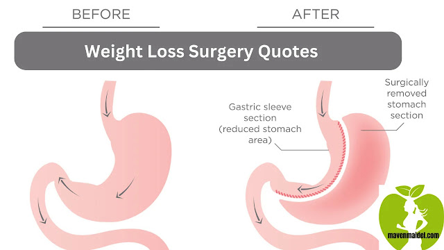 Weight Loss Surgery Quotes-A Guide Decoding The Expenses