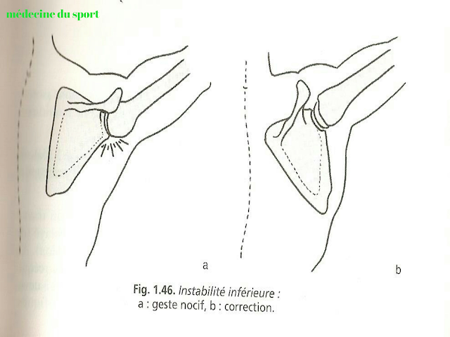 Les Luxations de l’épaule