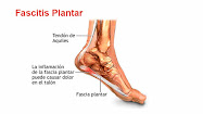 fascitis plantar