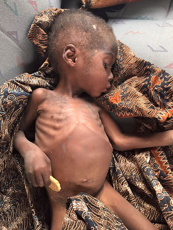 2-Year-Old ‘Witch Child’ Who Was Left To Die Makes Stunning Recovery - Hope was suffering from malnutrition and worms