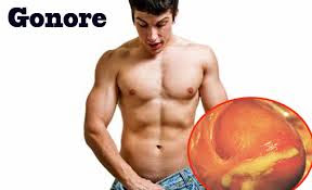 obat gonore