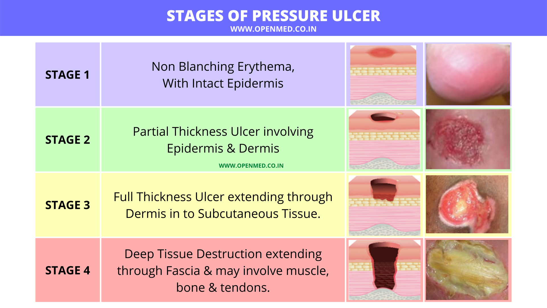 Pressure Ulcers Pressure Ulcer Ulcers Pressure The Best Porn Website