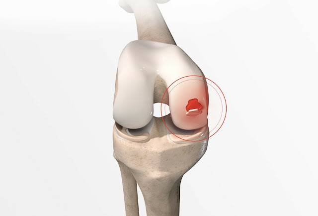 Knee Cartilage Repair Market