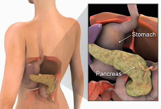 pancreatita acuta