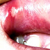 Mouth ulcer