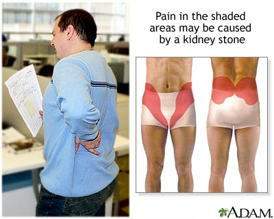Kidney Stones Symptoms Pictures