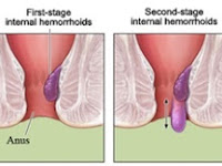 Wasir Tanpa Benjolan