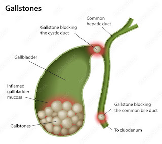 Symptoms of Gall Bladder Stone
