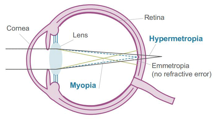 What is Anisometropia And it's Management ?