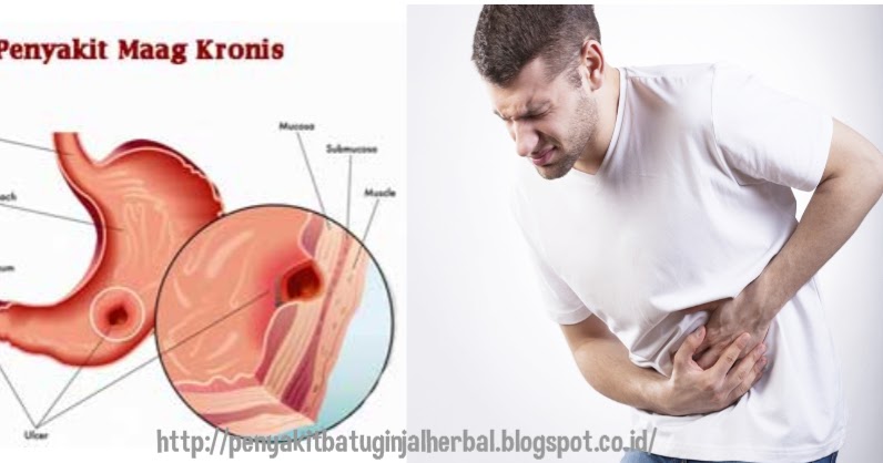  Cara Mengobati Penyakit Maag Kronis AHLINYA PENGOBATAN 