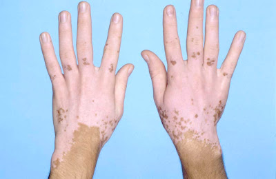 Vitiligo in Hands