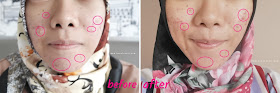 Before - After PHTE Avoskin