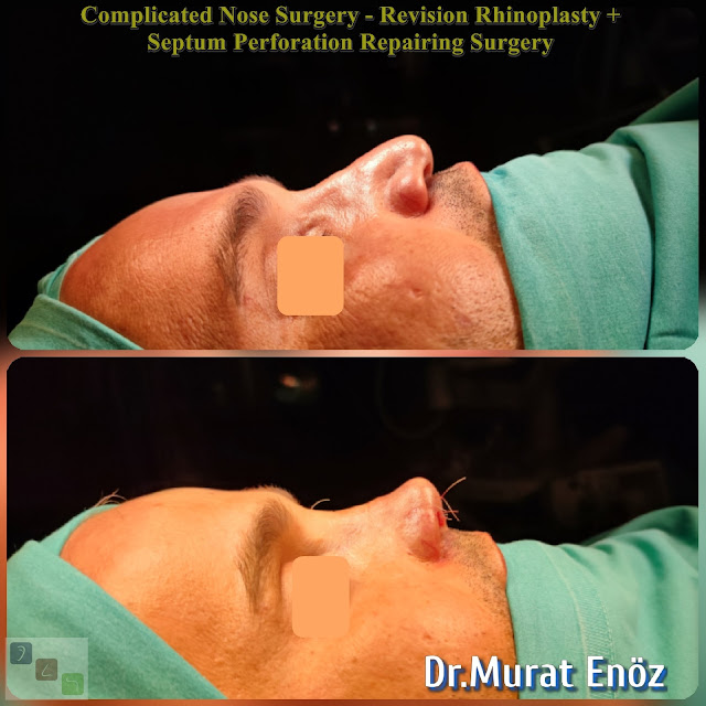 Complicated rhinoplasty, nasal septum perforation closore surgery,2nd Revision Male Rhinoplasty,Closure of nasal septum perforation with rib cartilage,