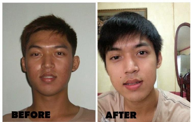 Kojic Soap Before And After | www.pixshark.com - Images 