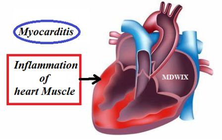 What is Myocarditis? What are Causes, Symptoms? How can Myocarditis be Treated? How can it be prevented?