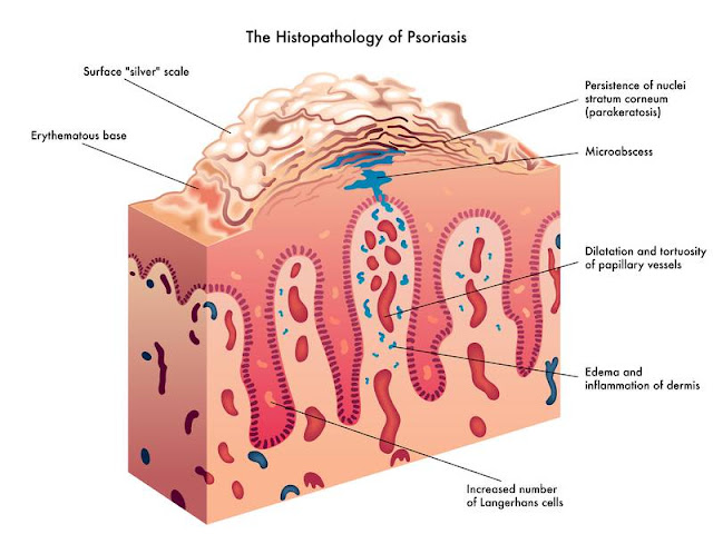 psoriasis síntomas