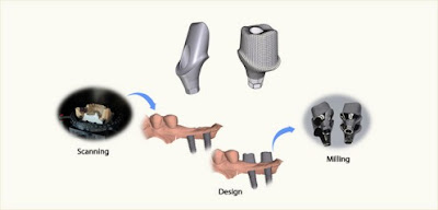 Cấy ghép răng Implant thực hiện như thế nào ?