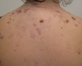 How to Get Rid of Back Acne?
