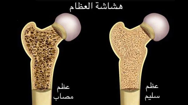 تُسبِّب هشاشة العظام ضعف العظام وهشتها — لدرجة أن أي سقوط أو مجهود بسيط مثل الانحناء أو السعال يمكن أن يسبّب كسورًا.