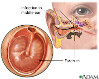 Pathophysiology of Chronic Otitis Media