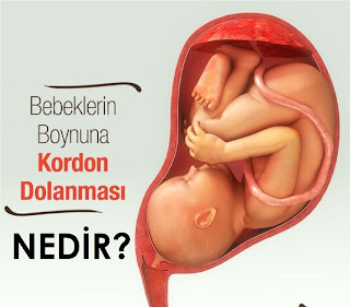 Kordon Dolanması