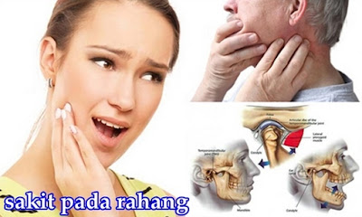 Obat Pembengkakan Pada Rahang Yang Alami Paling Ampuh Dan Efektif