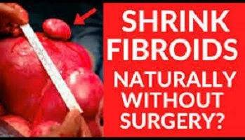 What is the Best Natural Remedy For Fibroid?