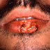 Cold Sore Treatment With Abreva : Causes Of Cold Sores - Stop Repeated Cold Sore Attacks