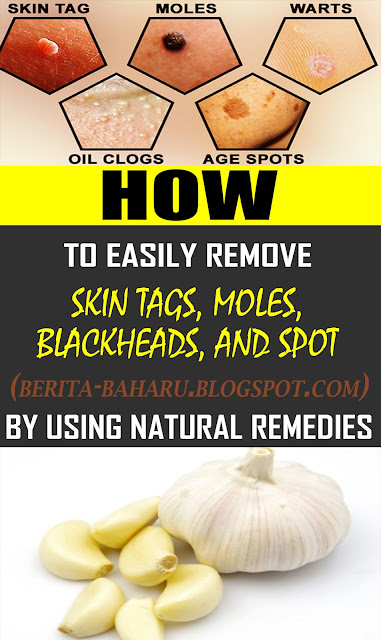  HOW TO EASILY REMOVE SKIN TAGS, MOLES, BLACKHEADS, SPOTS AND WARTS BY USING NATURAL REMEDIES