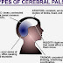Macam-Macam Type Penyakit Cerebral Palsy -1